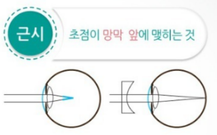 [건강칼럼]정시, 근시, 원시, 난시란? 9