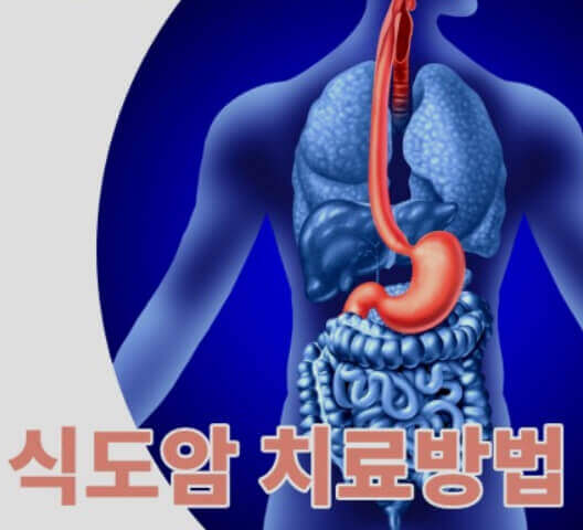 식도암 유발의 생활 습관 점검 및 면역 항암제 최신 치료법 알아보기