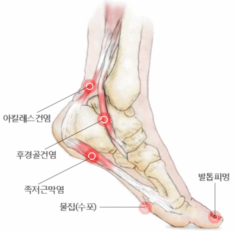 발목아픈이유 발목 부위별로 통증을