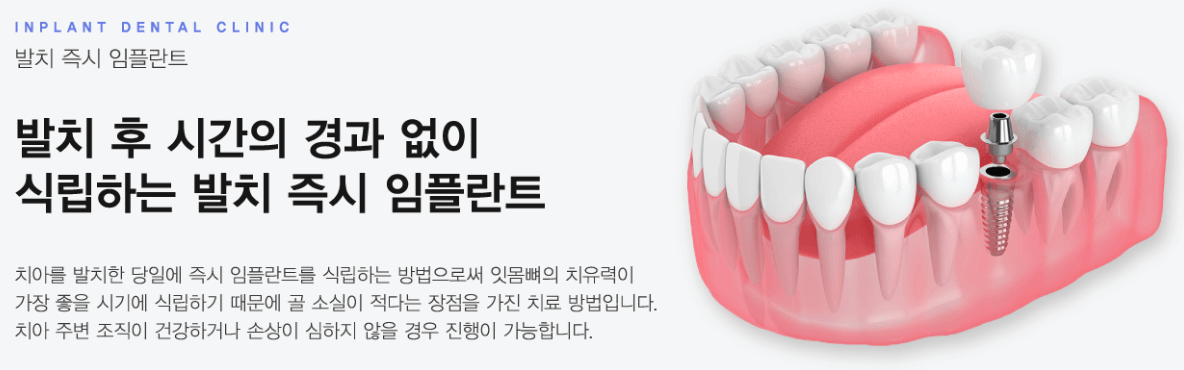 임플란트 가격 임플란트 종류 비교