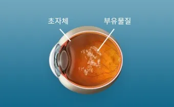 비문증 원인 영양제 종류 치료방법_6