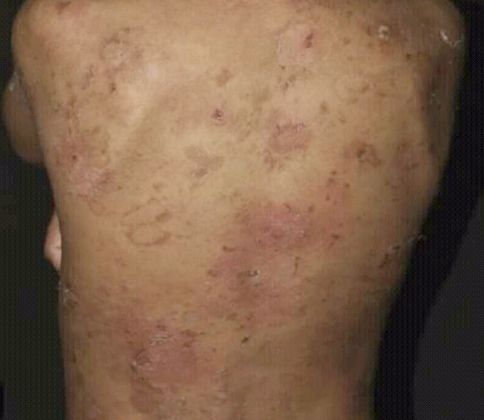  어린선 피부비늘증 신생아 어린선