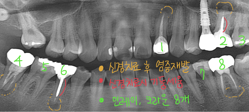 치아보험 예시 엑스레이