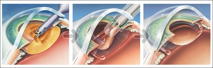 노안교정술 백내장수술 종류 방법 렌즈삽입술 노안라식 라섹