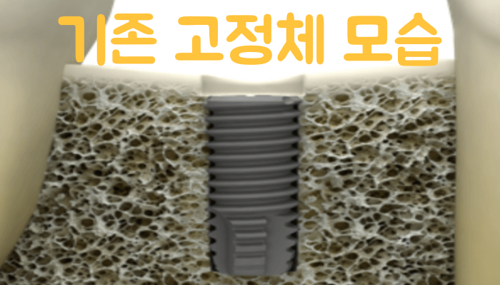 기존의-메가젠-임플란트-고정체