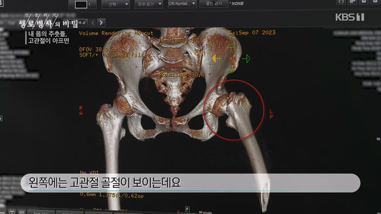 생로병사의 비밀.E890.231116p-NEXT.mp4_20231116_204849.089.jpg