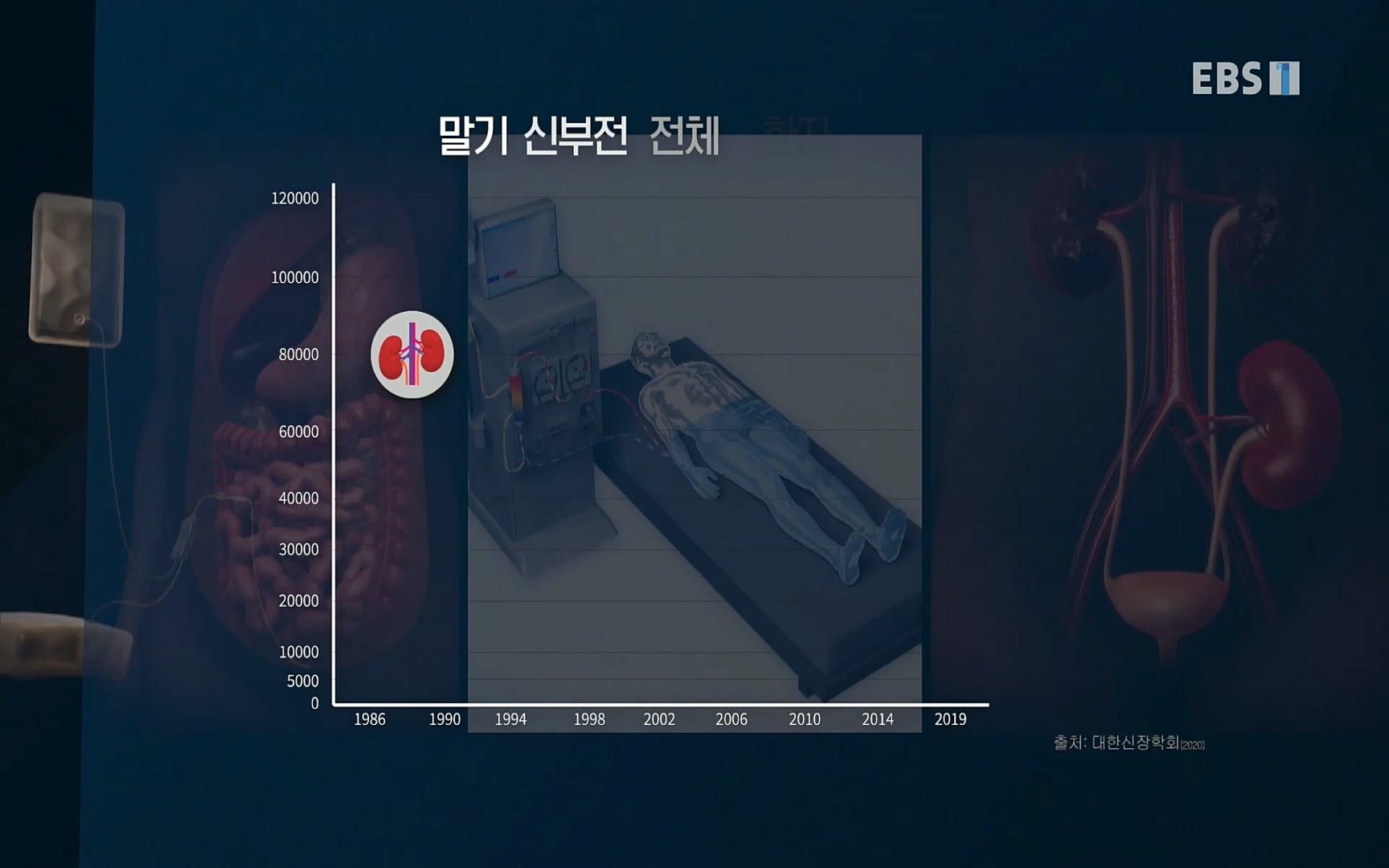 EBS 명의 헬스케어 - TV - 교육의 중심 EBS명의 15년 - 만성 콩팥병 치료, 어디까지 왔나- .mp4_20220802_205723.492.jpg