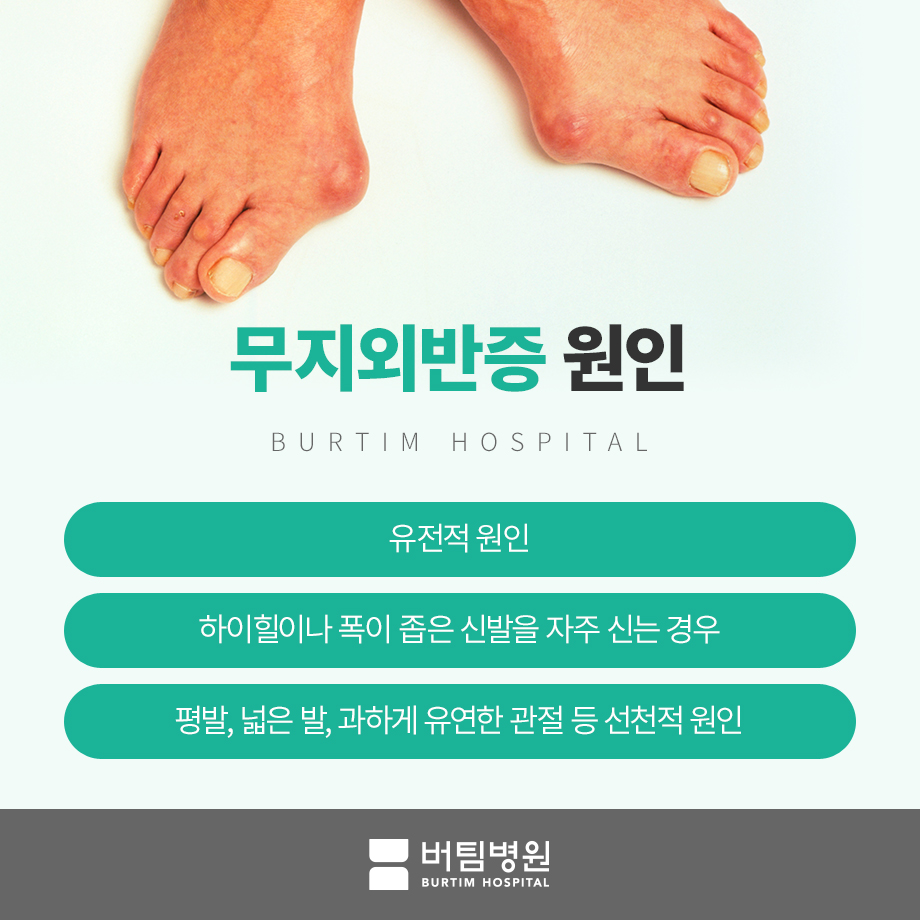 외반 모지는 또한 무릎과 척추에 영향을 미칩니다 8