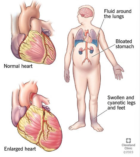 울혈성 심부전 Congestive heart failure