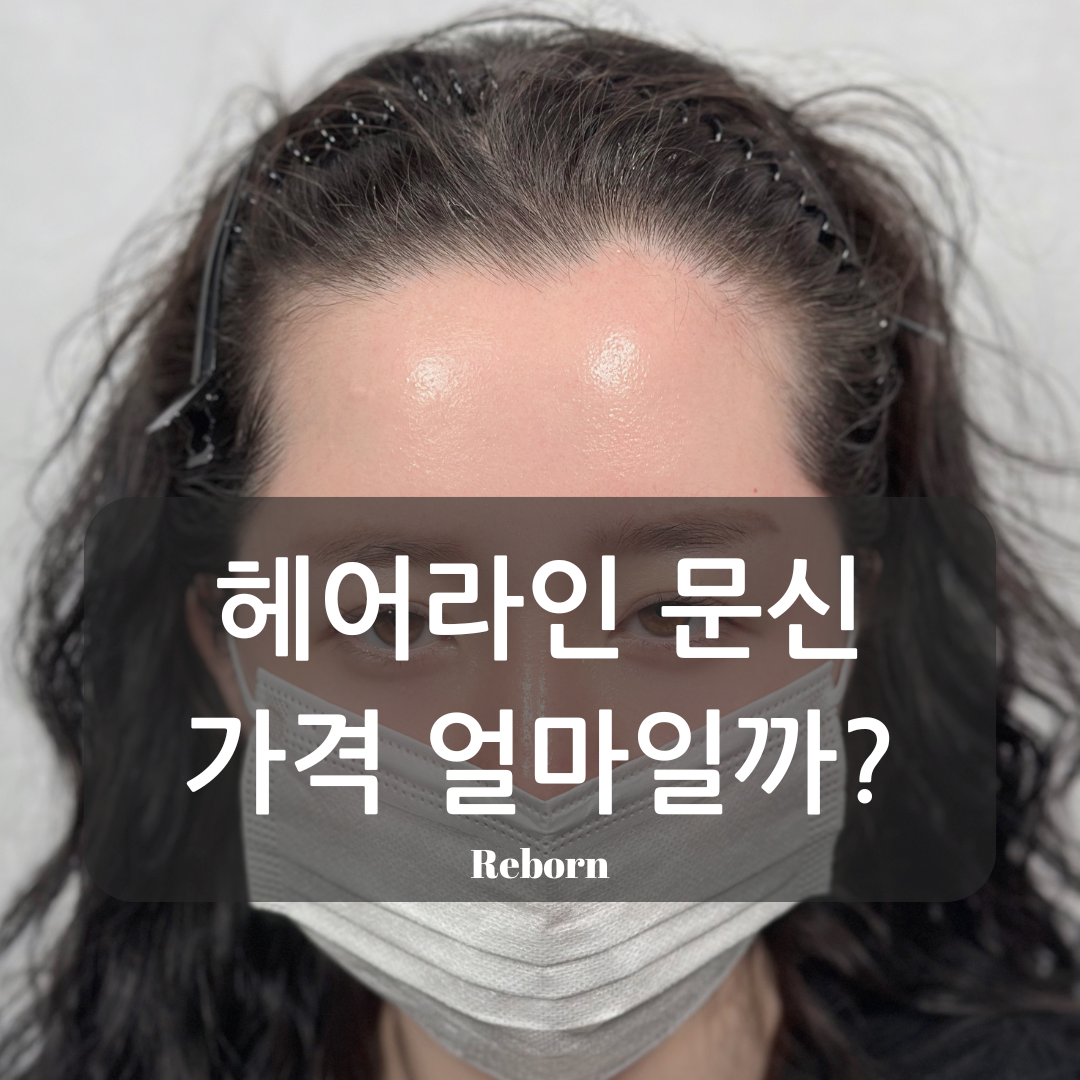  부산두피문신,부산헤어라인 엠자 탈모 탈출! 이마 필러 효과 얻는 방법!!
