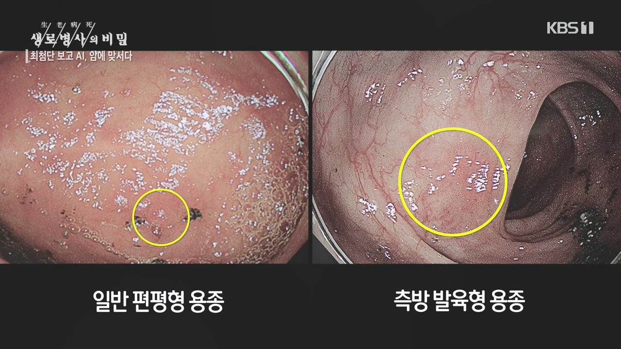 생로병사의 비밀.E881.230831p-NEXT.mp4_20230901_223246.305.jpg