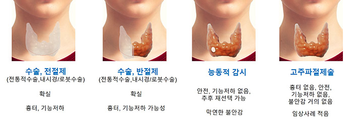 갑상선암 수술 / 갑상선 / 갑상선 수술