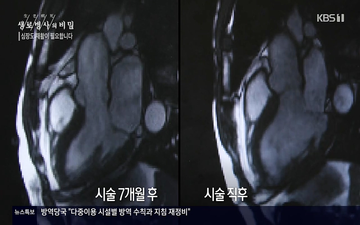 생로병사의 비밀.E820.220428p-NEXT.mp4_20220501_185255.825.jpg