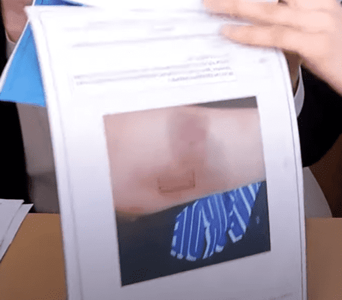 멍이 들고 밴드를 붙힌 쯔양의 신체