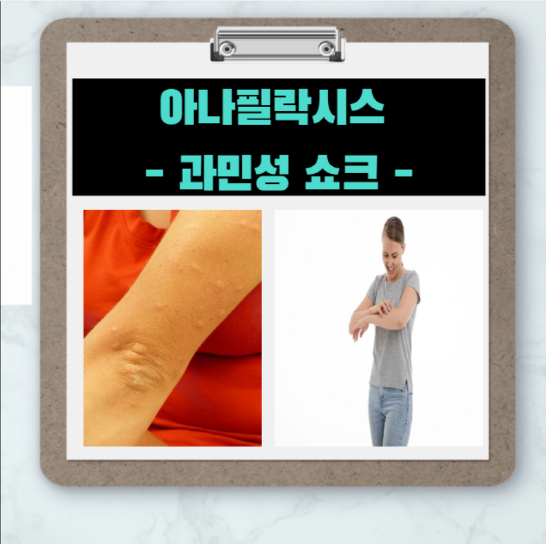  '아나필락시스' 쇼크에서 사망까지 이르는 원인