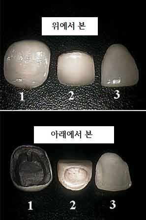 의학용어 veneer 뜻 베니어, 라미네이트 의학용어 Veneer 뜻 베니어, 라미네이트