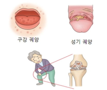  베체트 병 증상과 치료
