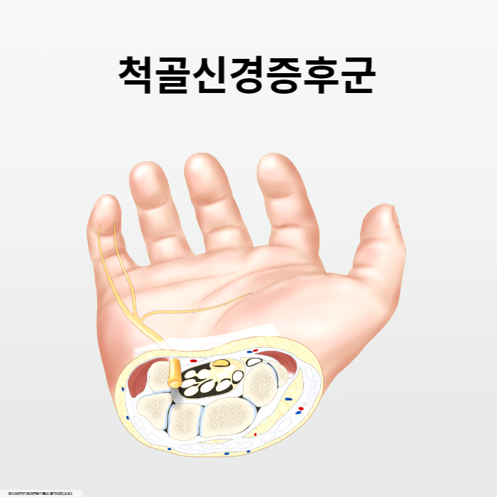 척골신경증후군