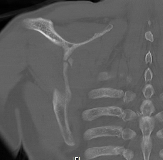 scapular coronal image