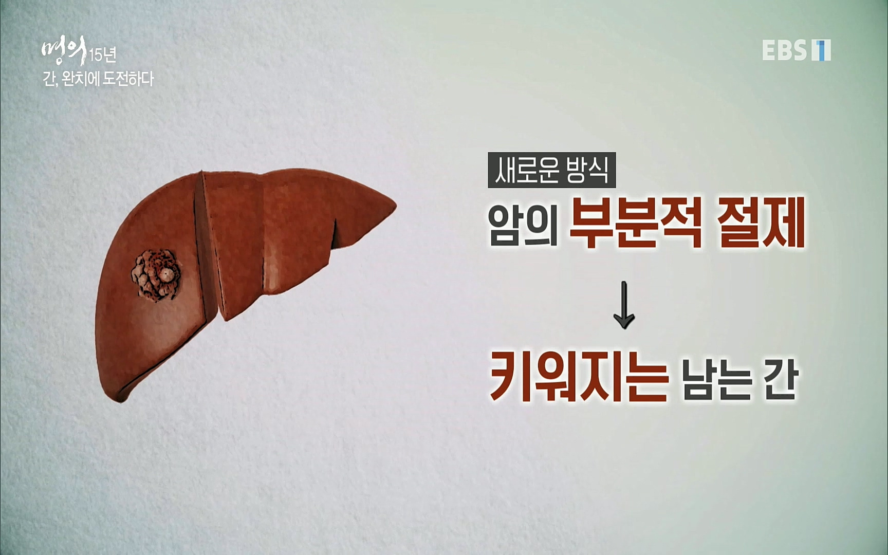 EBS 명의 헬스케어 - TV - 교육의 중심 EBS명의 15년 - 간, 완치에 도전하다.mp4_20220802_202424.494.jpg