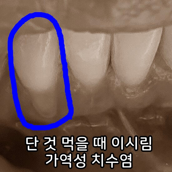 가역성 치수염 참고 사진