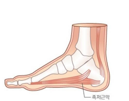 족저근막염 증상