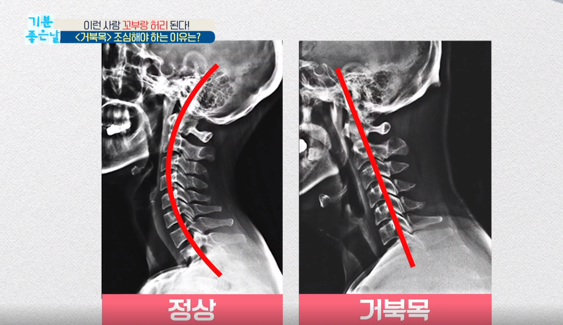  두통 유발하는 일자목 거북목 증후군, 초간단 자가진단법과 생활 속 교정 스트레칭!