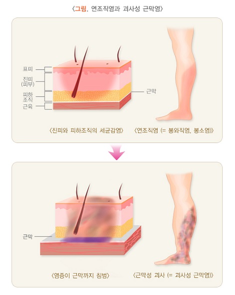 연조직염(봉와직염&#44;봉소염)과 괴사성 근막염