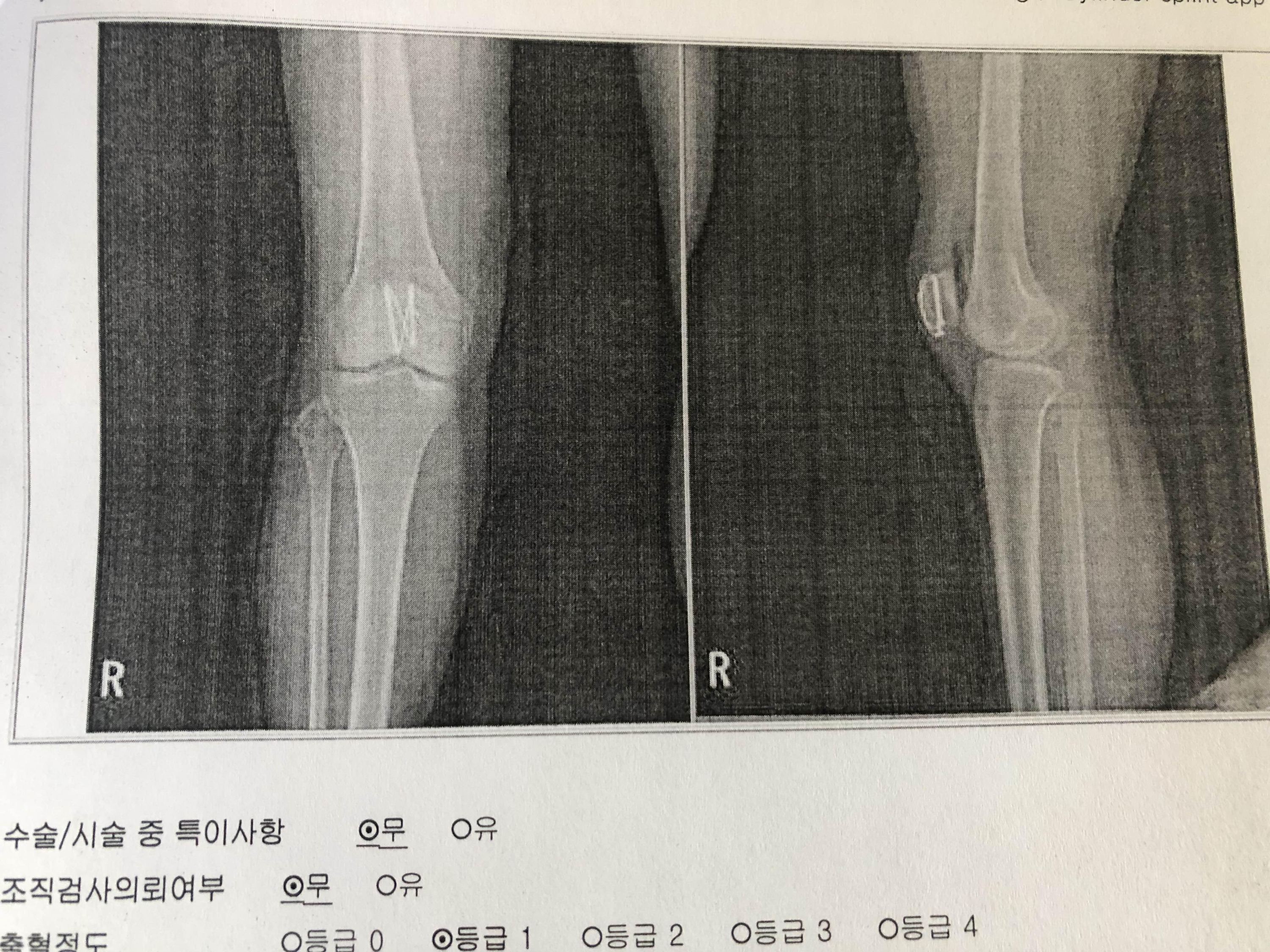 슬개골골절수술-와이어로고정한-내슬개골사진