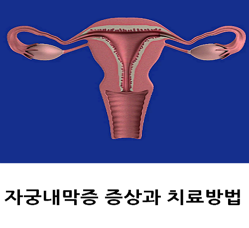 자궁내막증 증상과 치료방법