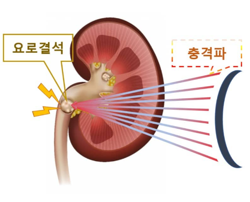 체외 충격파 쇄석술