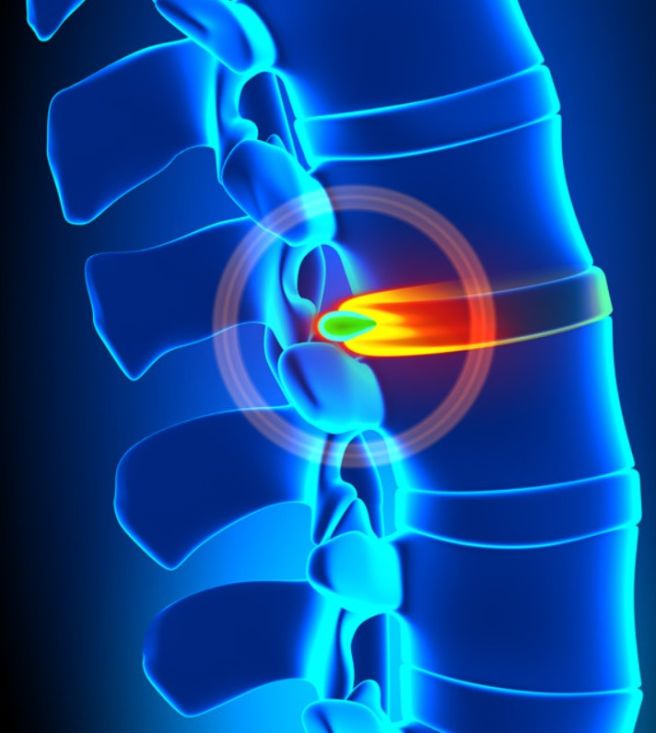 허리디스크 초기증상