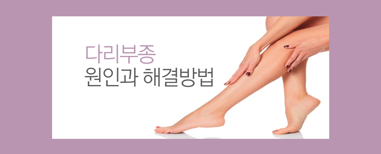  다리부종 원인 | 다리부종 마사지 | 다리부종 약 | 다리부종 치료방법 | 다리부종 영양제 | 다리부종 치료법