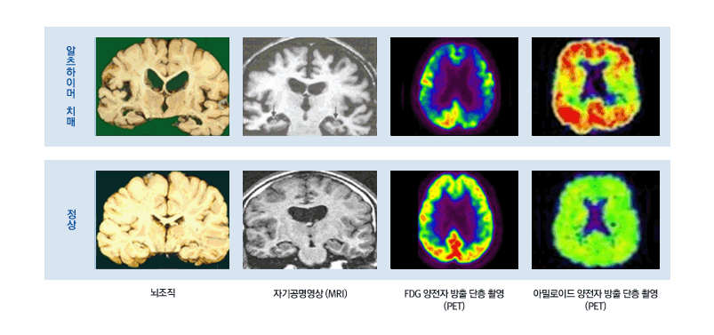 정상인과 치매환자 뇌 비교