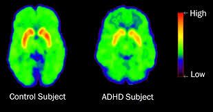  ADHD 자가 진단 테스트 증상 치료 방법