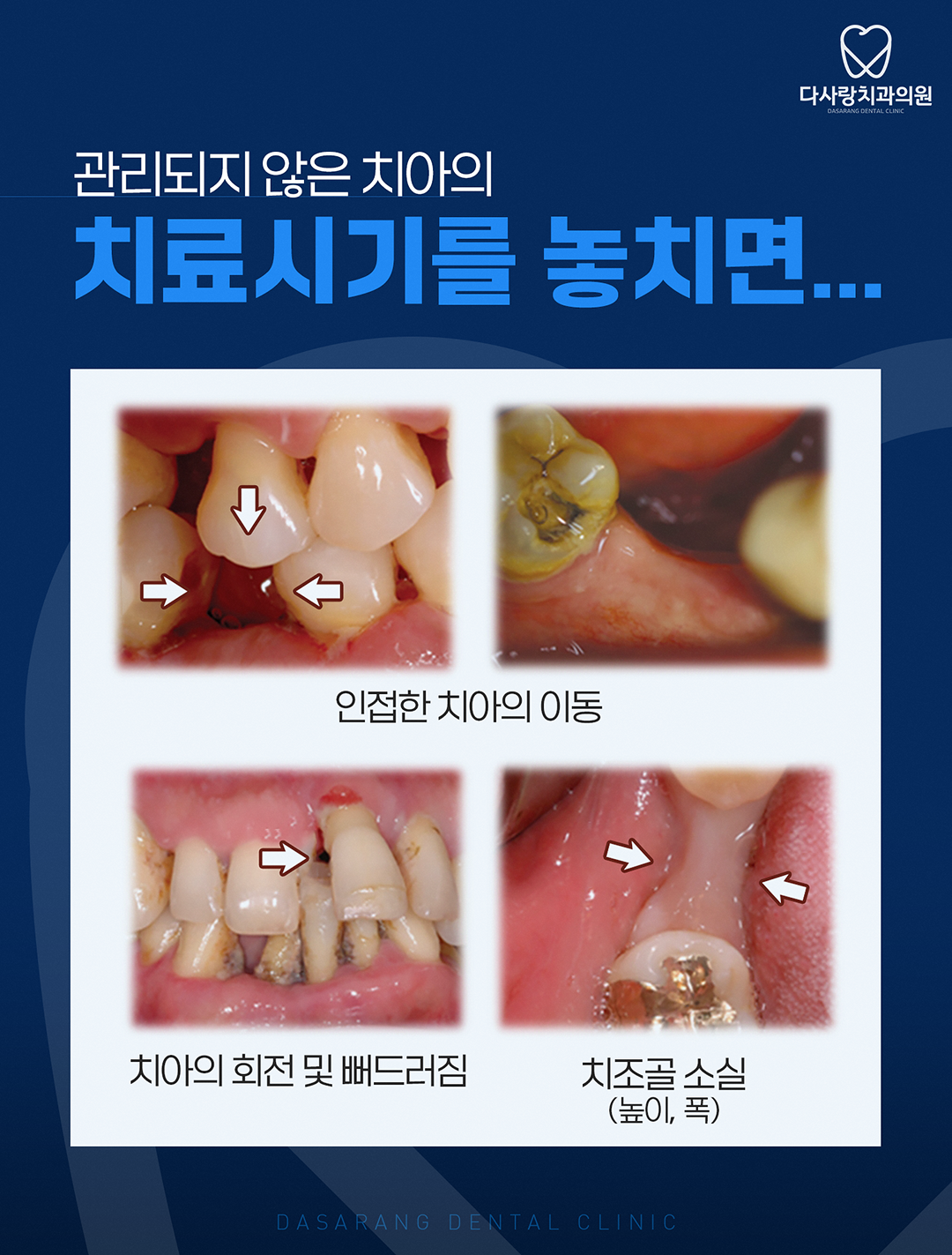  장위동치과 임플란트 고르는 기준을 공개합니다!