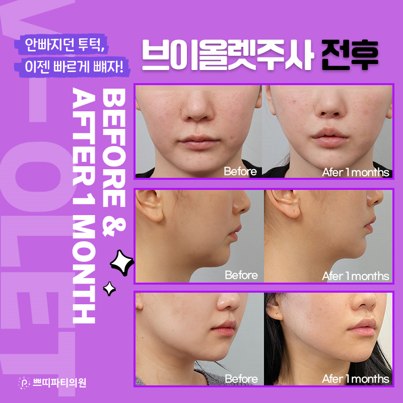  얼굴지방분해주사 브이올렛주사 원리와 효과 가격까지 알아보기