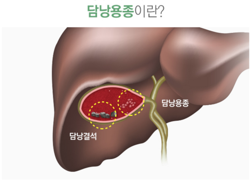 쓸개(담낭) 제거수술