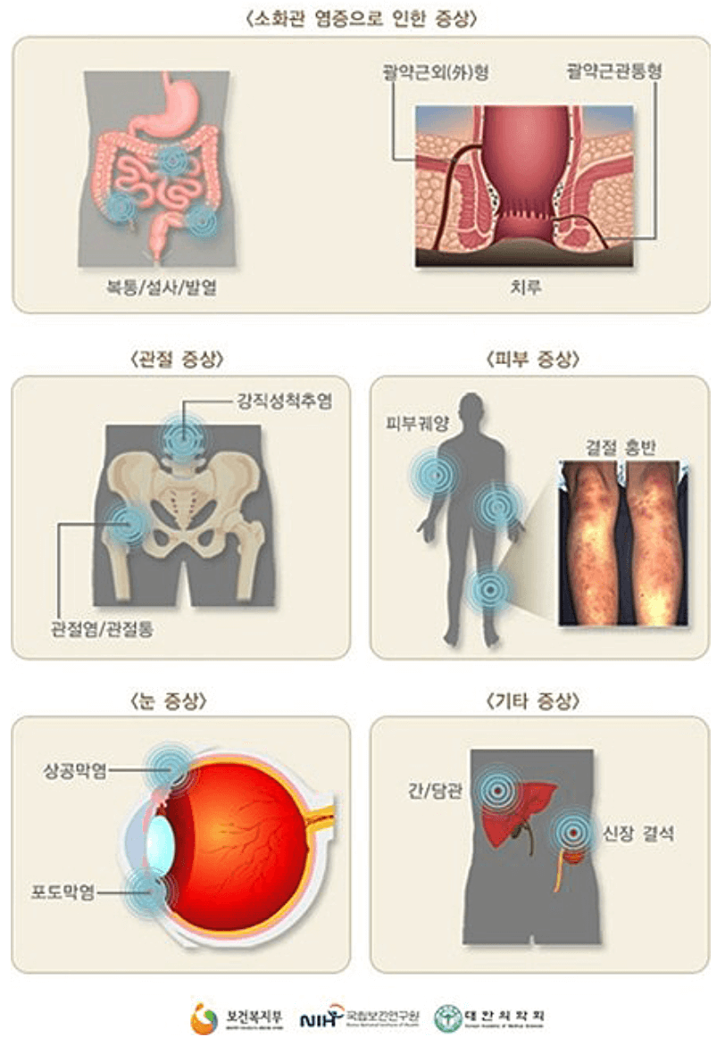 크론병 증상