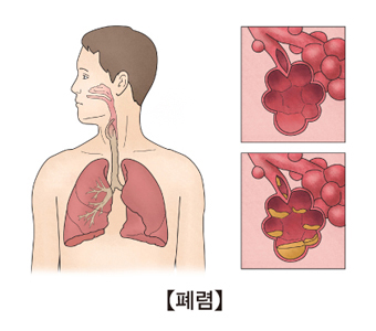 폐렴