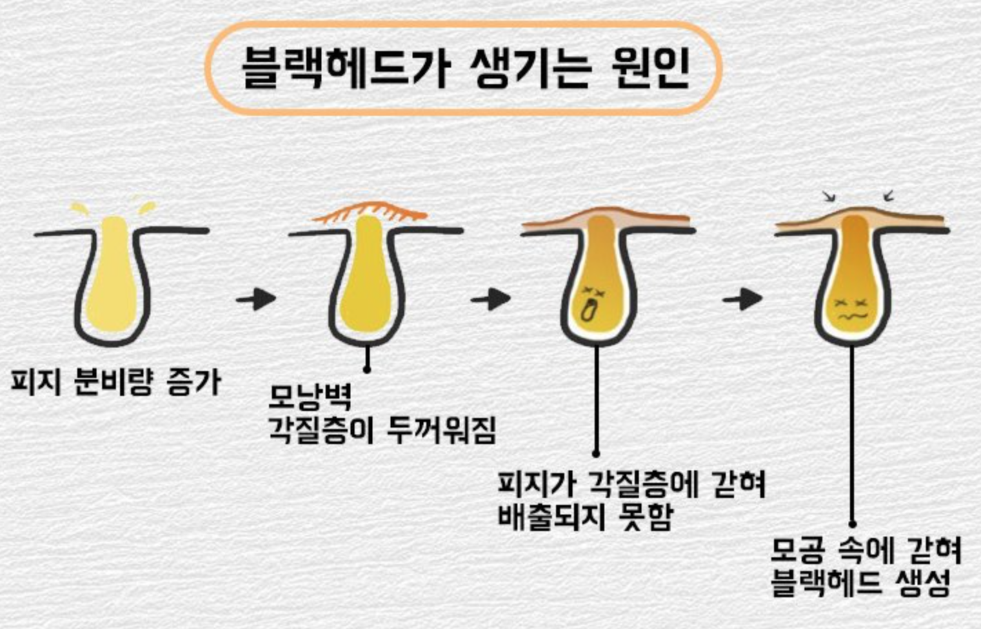 블랙헤드가 생기는 단계 표