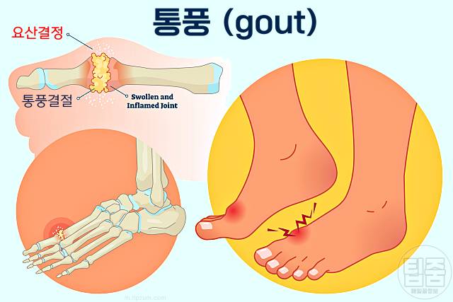 통풍의 초기 증상 엄지발가락 통증의 원인 통풍의 증상