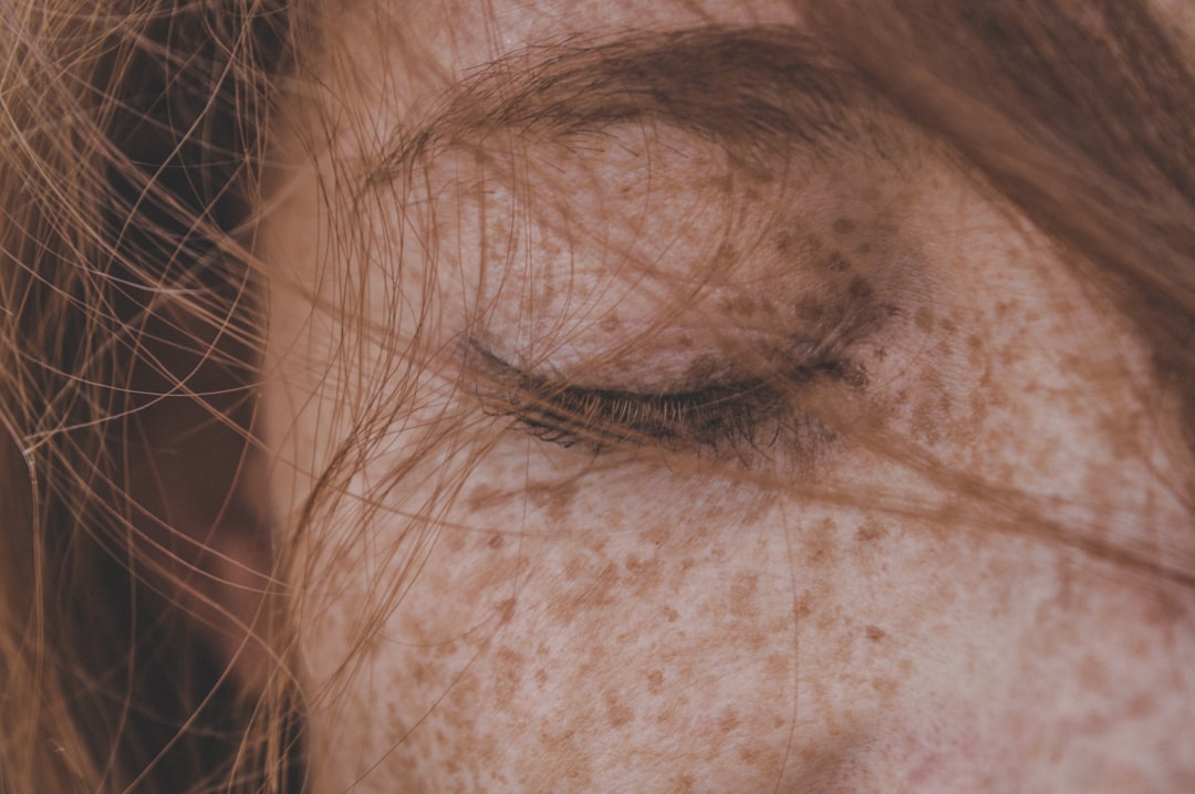 Freckles
