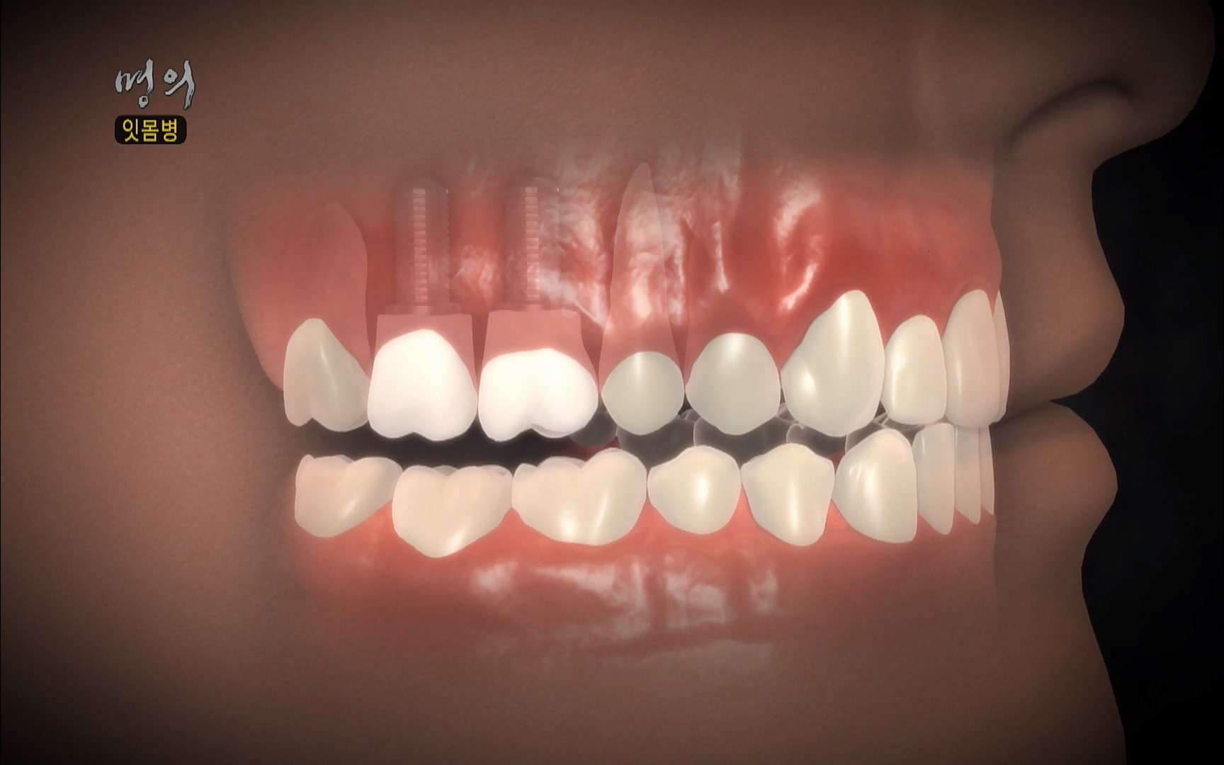 EBS 명의 헬스케어 - TV - 교육의 중심 EBS2015년 1월 16일 (금) 밤 9시 50분, EBS1.mp4_20220505_150406.337.jpg