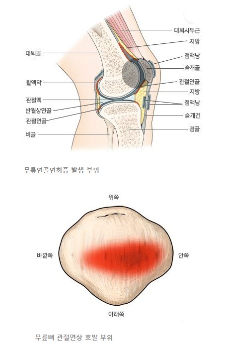 무릎연골연화증