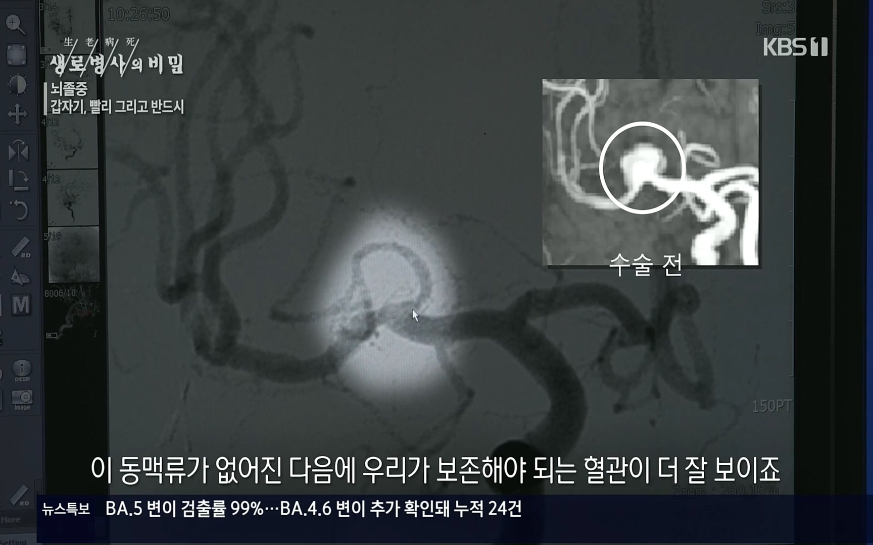 생로병사의 비밀.E835p.H264-F1RST.mp4_20220917_181744.137.jpg