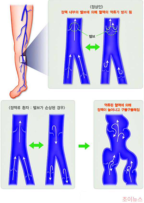 하지정맥류가 혈관에서 발생되는 모습