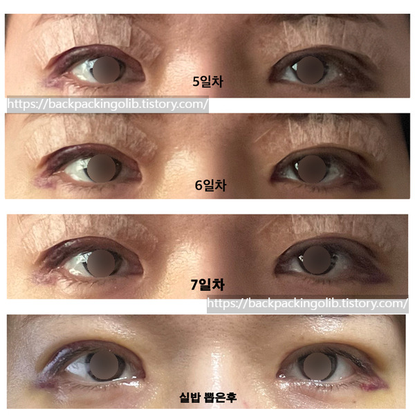 쌍수 5일~8일차