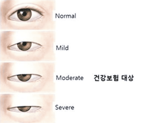 안검하수 수술 가격, 수술비용, 보험적용 여부 알아보기 안검하수 수술 가격, 수술비용, 보험적용 여부 알아보기
