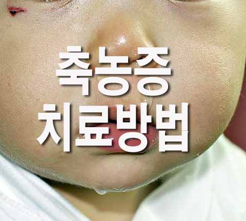  축농증 치료방법(+좋은 음식)